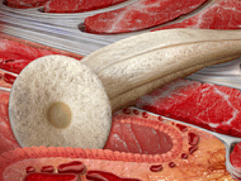 Image: The Gore BIO-A Fistula Plug (Photo courtesy of Gore Medical). Image: The Gore BIO-A Fistula Plug (Photo courtesy of Gore Medical).